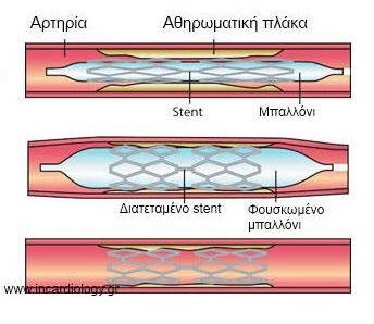 stent